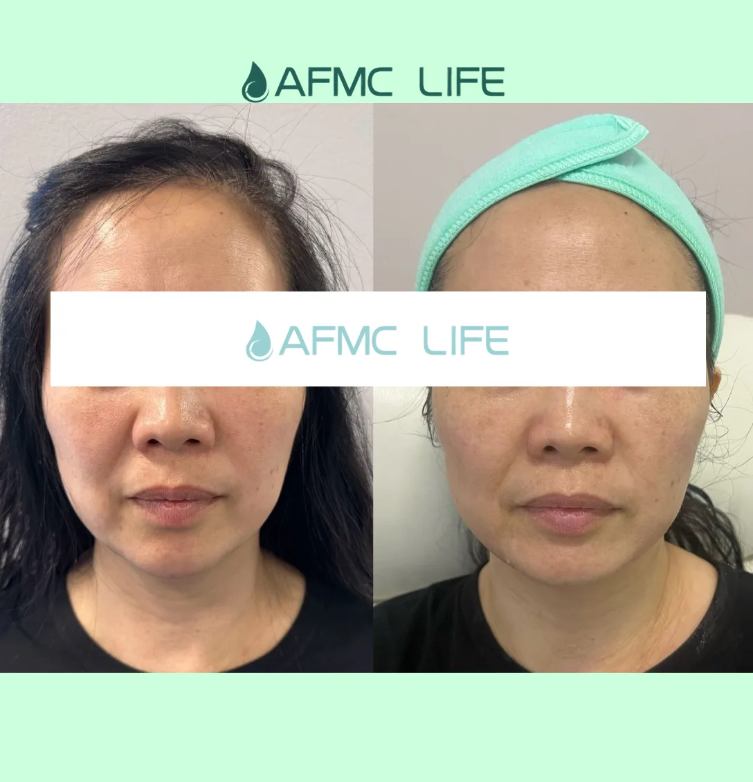 sofwave trial